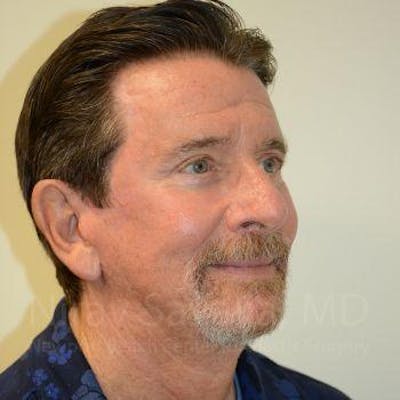 Facelift Before & After Gallery - Patient 1655726 - After1