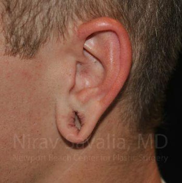Torn Earlobe Repair Ear Gauge Repair Before & After Gallery - Patient 1655727 - Before1