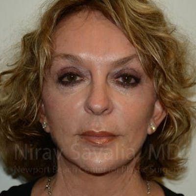 Fat Grafting to Face Before & After Gallery - Patient 1655730