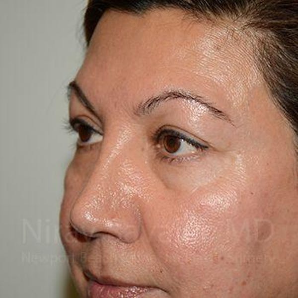 Eyelid Surgery Before & After Gallery - Patient 1655728 - Before1