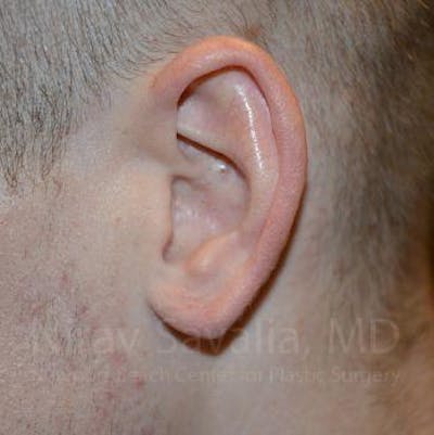 Torn Earlobe Repair Ear Gauge Repair Before & After Gallery - Patient 1655727 - After1