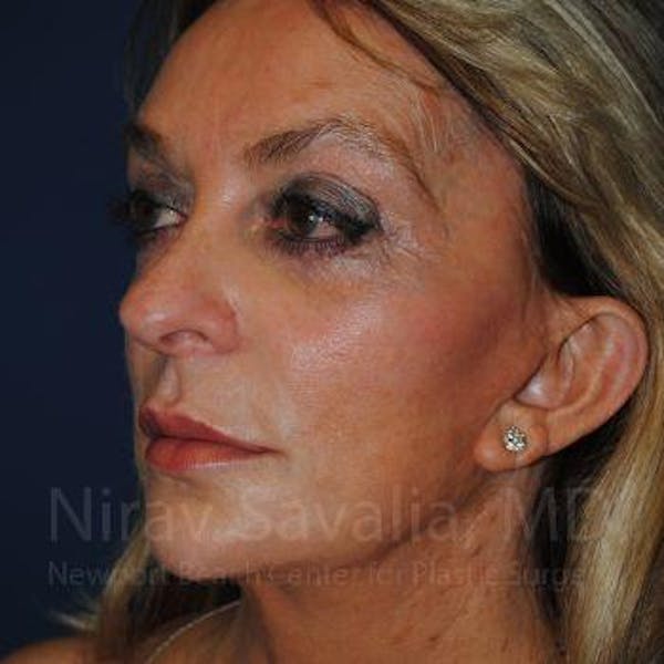 Fat Grafting to Face Before & After Gallery - Patient 1655730 - Before1