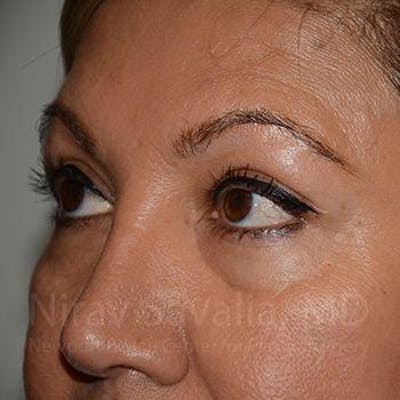 Eyelid Surgery Before & After Gallery - Patient 1655728 - After1