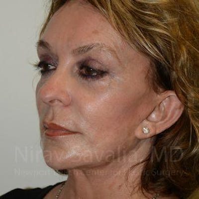 Fat Grafting to Face Before & After Gallery - Patient 1655730 - After1