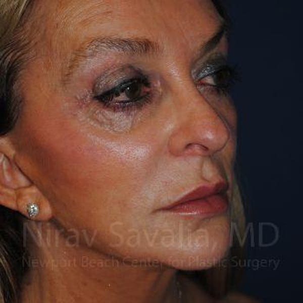 Fat Grafting to Face Before & After Gallery - Patient 1655730 - Before1