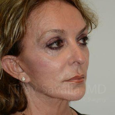 Fat Grafting to Face Before & After Gallery - Patient 1655730 - After1