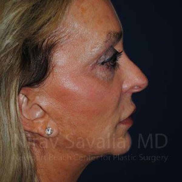 Fat Grafting to Face Before & After Gallery - Patient 1655730 - Before1