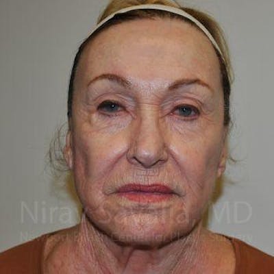 Facelift Before & After Gallery - Patient 1655786 - After1
