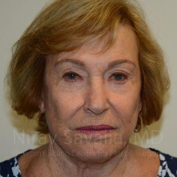 Facelift Before & After Gallery - Patient 1655786 - Before1