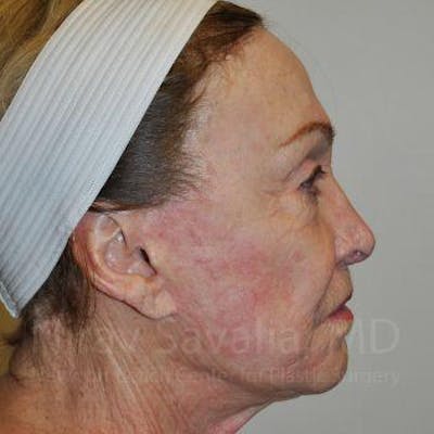 Facelift Before & After Gallery - Patient 1655786 - Before1