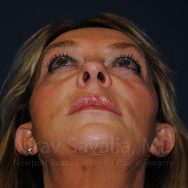 Fat Grafting to Face Before & After Gallery - Patient 1655730 - Before1