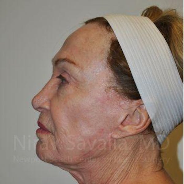 Facelift Before & After Gallery - Patient 1655786 - Before1