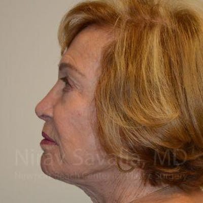 Facelift Before & After Gallery - Patient 1655786 - After1