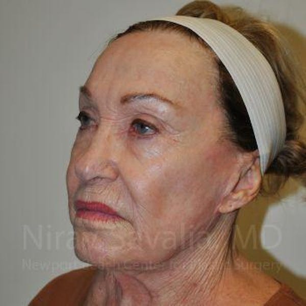 Facelift Before & After Gallery - Patient 1655786 - Before1