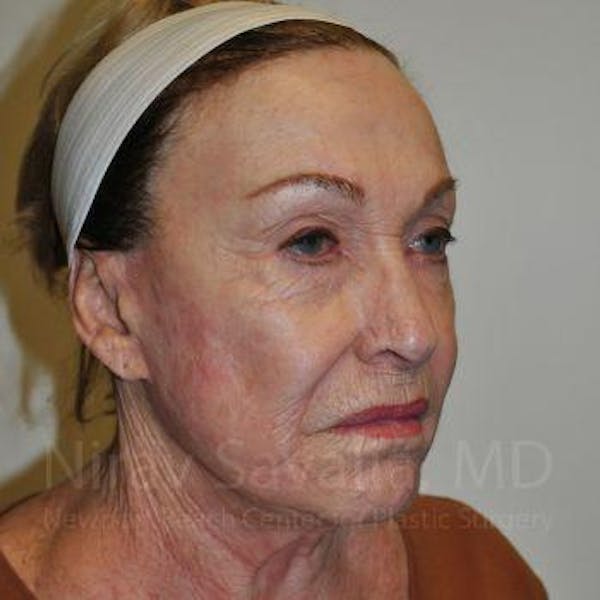 Facelift Before & After Gallery - Patient 1655786 - Before1