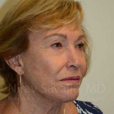 Facelift Before & After Gallery - Patient 1655786 - After1