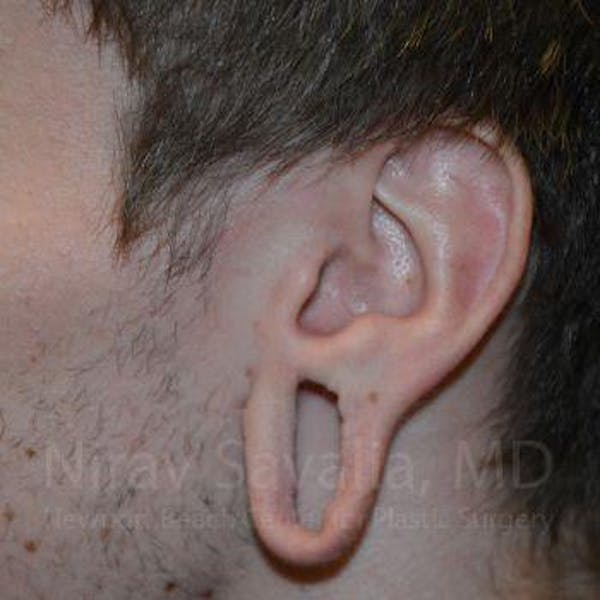 Torn Earlobe Repair Ear Gauge Repair Before & After Gallery - Patient 1655788 - Before1
