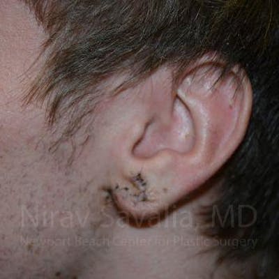 Torn Earlobe Repair Ear Gauge Repair Before & After Gallery - Patient 1655788 - After1