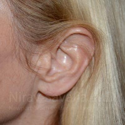 Torn Earlobe Repair Ear Gauge Repair Before & After Gallery - Patient 1655794