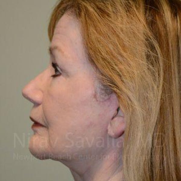 Facelift Before & After Gallery - Patient 1655795 - Before1