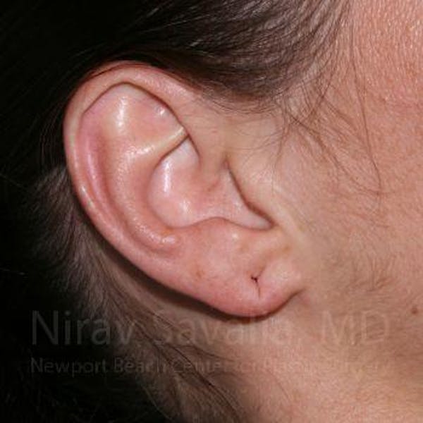 Torn Earlobe Repair Ear Gauge Repair Before & After Gallery - Patient 1655797 - Before1