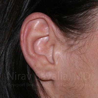 Torn Earlobe Repair Ear Gauge Repair Before & After Gallery - Patient 1655797 - After1