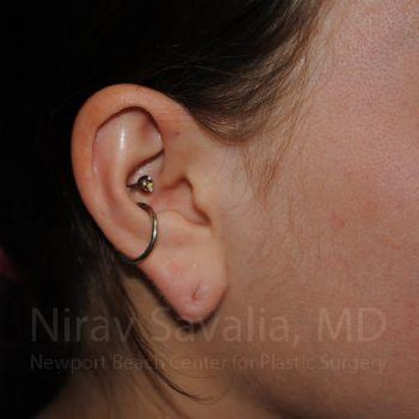 Torn Earlobe Repair Ear Gauge Repair Before & After Gallery - Patient 1655798 - Before1