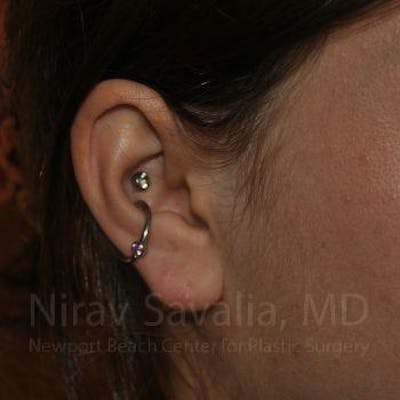 Torn Earlobe Repair Ear Gauge Repair Before & After Gallery - Patient 1655798 - After1