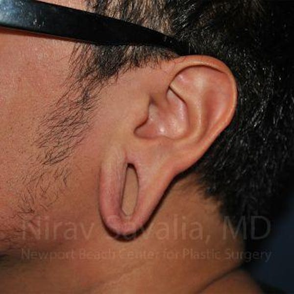 Torn Earlobe Repair Ear Gauge Repair Before & After Gallery - Patient 1655801 - Before1