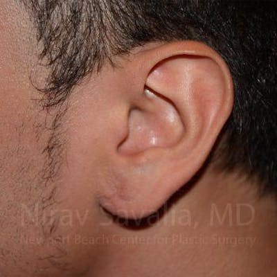 Torn Earlobe Repair Ear Gauge Repair Before & After Gallery - Patient 1655801 - After1