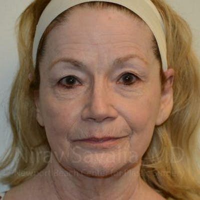 Eyelid Surgery Before & After Gallery - Patient 1655803