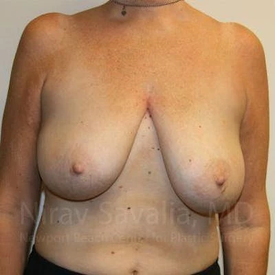 Breast Lift without Implants Before & After Gallery - Patient 1655450