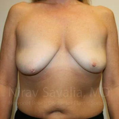 Mastectomy Reconstruction Before & After Gallery - Patient 1655464