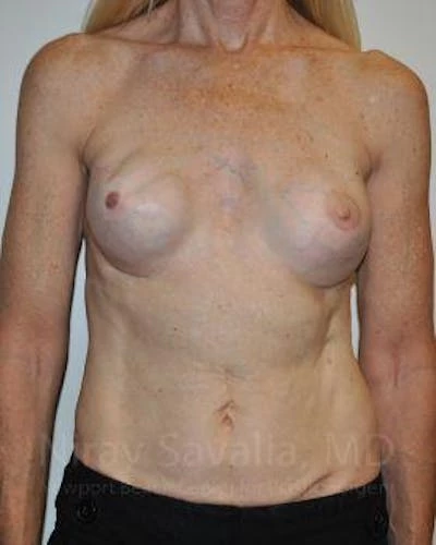 Mastectomy Reconstruction Revision Before & After Gallery - Patient 1655466