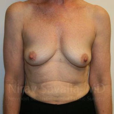 Oncoplastic Reconstruction Before & After Gallery - Patient 1655475