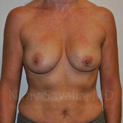 Mastectomy Reconstruction Before & After Gallery - Patient 1655474