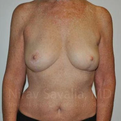 Oncoplastic Reconstruction Before & After Gallery - Patient 1655481