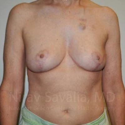 Oncoplastic Reconstruction Before & After Gallery - Patient 1655487