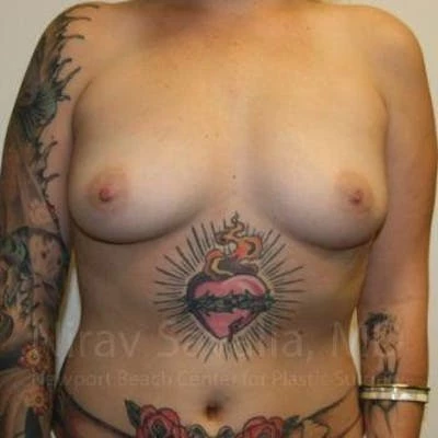 Breast Augmentation Before & After Gallery - Patient 1655500