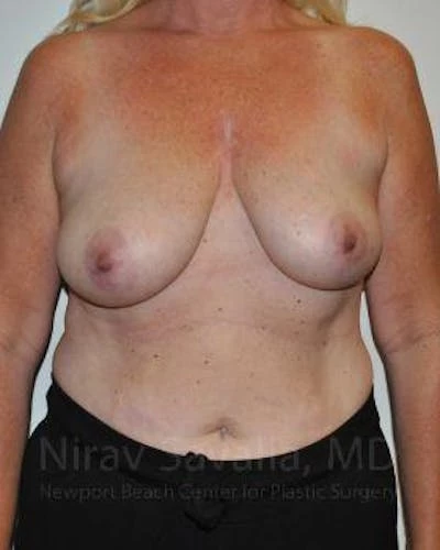 Oncoplastic Reconstruction Before & After Gallery - Patient 1655499