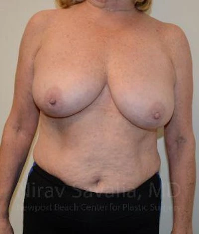 Breast Lift without Implants Before & After Gallery - Patient 1655501