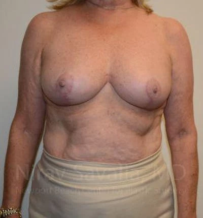 Breast Lift without Implants Before & After Gallery - Patient 1655501