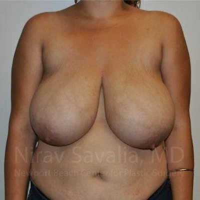 Breast Reduction Before & After Gallery - Patient 1655504