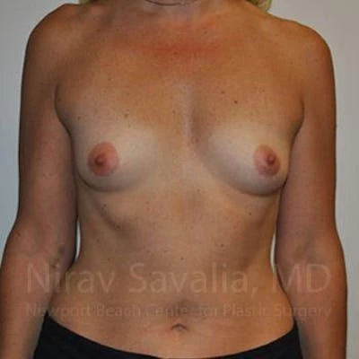 Breast Augmentation Before & After Gallery - Patient 1655512