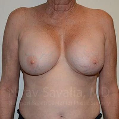 Breast Implant Revision Before & After Gallery - Patient 1655513