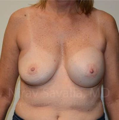 Breast Implant Revision Before & After Gallery - Patient 1655547