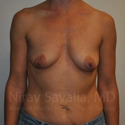 Breast Augmentation Before & After Gallery - Patient 1655550