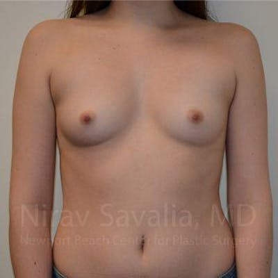 Breast Augmentation Before & After Gallery - Patient 1655555 - Image 1