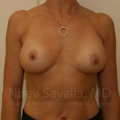 Breast Implant Revision Before & After Gallery - Patient 1655556