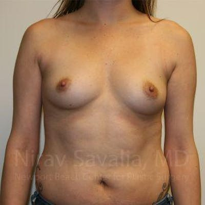 Breast Augmentation Before & After Gallery - Patient 1655557 - Image 1